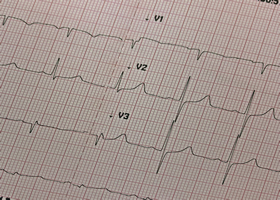 electrocardiograma